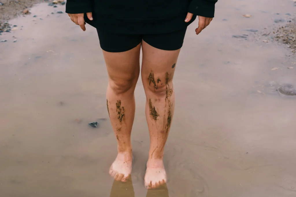 Why Is Only My Left Leg Swelling? 3 Shocking Causes Revealed