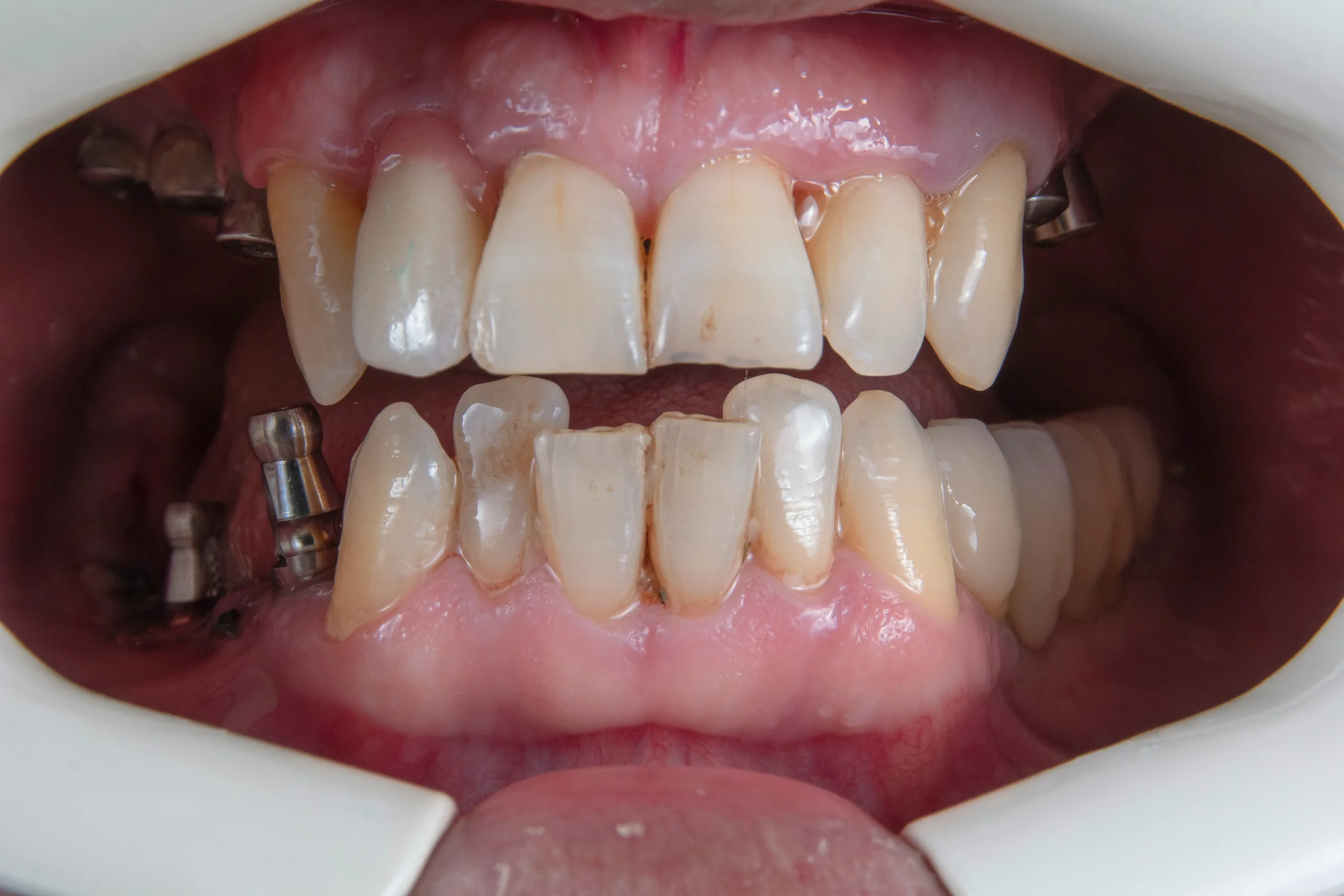 Why are my teeth yellow when i brush them everyday 6 Proven Tips to Brighten Teeth 1 Why are my teeth yellow when i brush them everyday