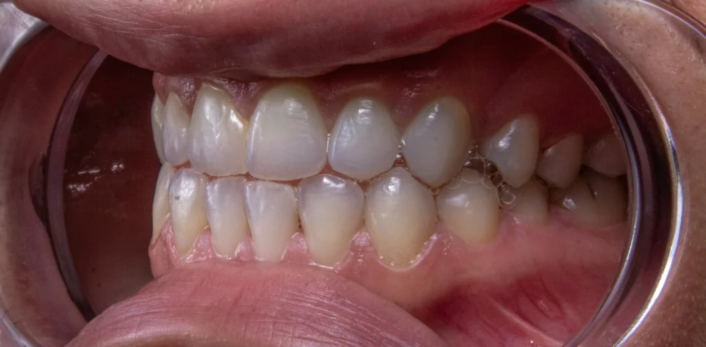 Why are my teeth yellow when i brush them everyday 6 Proven Tips to Brighten Teeth 3 Why are my teeth yellow when i brush them everyday??