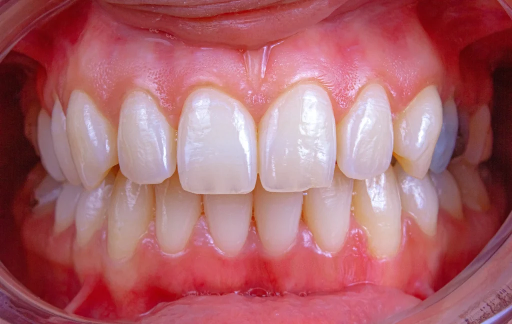 Why are my teeth yellow when i brush them everyday 6 Proven Tips to Brighten Teeth 2 Why are my teeth yellow when i brush them everyday