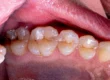 Why Does My Tooth Filling Hurt After Months